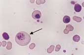 Ematologia